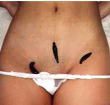 Terapie cu Lipitori: Probleme ale Sistemului de Reproducere OBGYN / Feminin